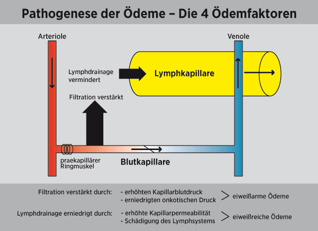 grafik_oedemkrankheiten-2_01.gif 